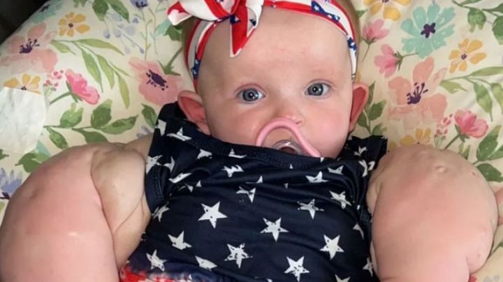 Ella es ‘Baby Hulk’, la niña que nació con una extraña enfermedad y luce enormes brazos